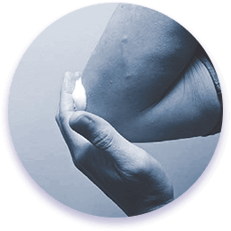 Step 5: A patient applying the foam onto their elbow.